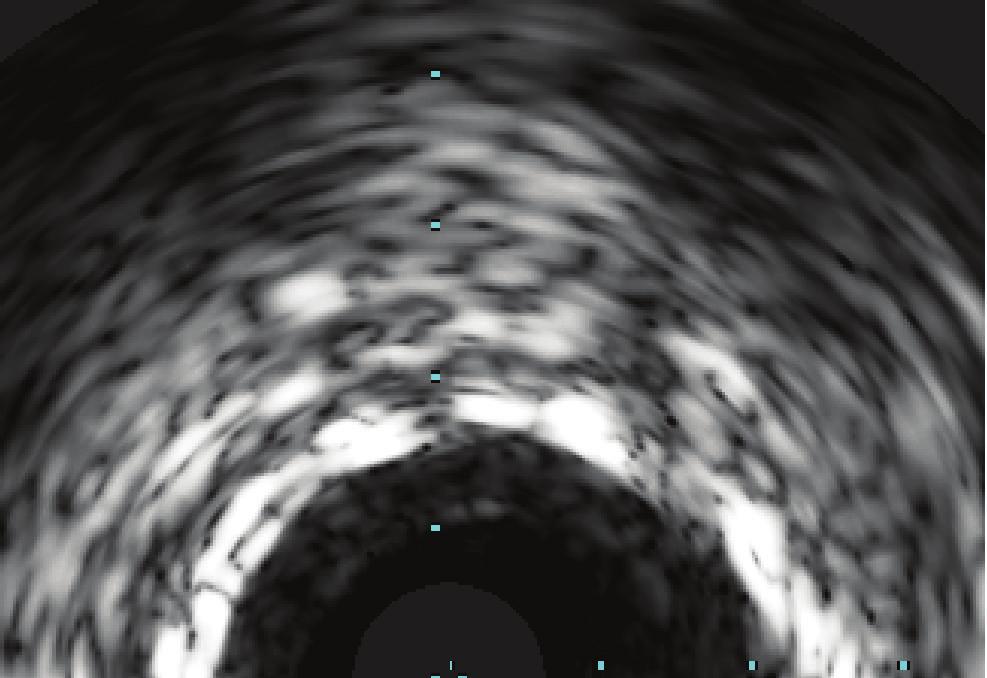 3 (a) (b) (c) Figure 2: Intravascular ultrasound (IVUS) (a) shows moderate hyperplasia of the intima and well-apposition of the PTFE-covered stent to the first implanted stent.