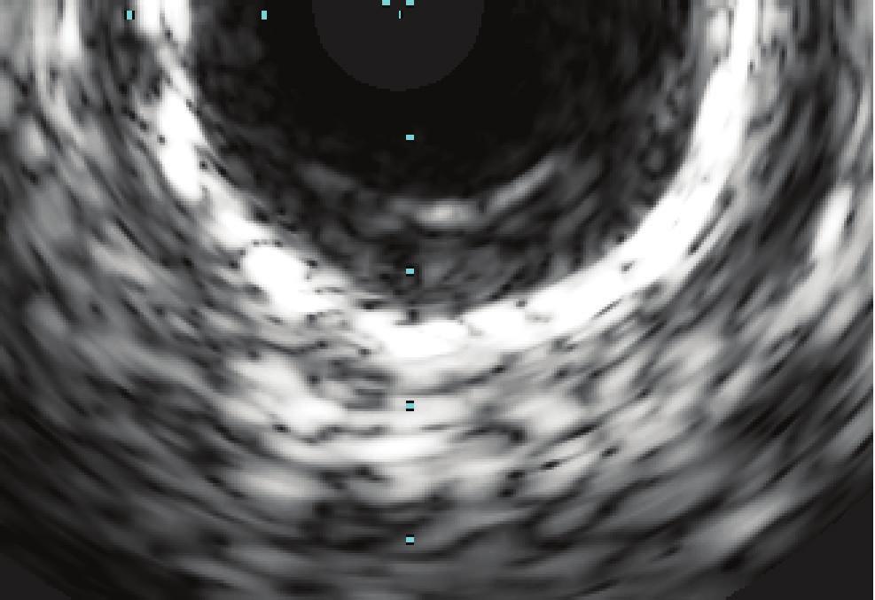 Both IVUS and right coronary angiography were done 11 months after the incident. drug-eluting (92%) stents [4].