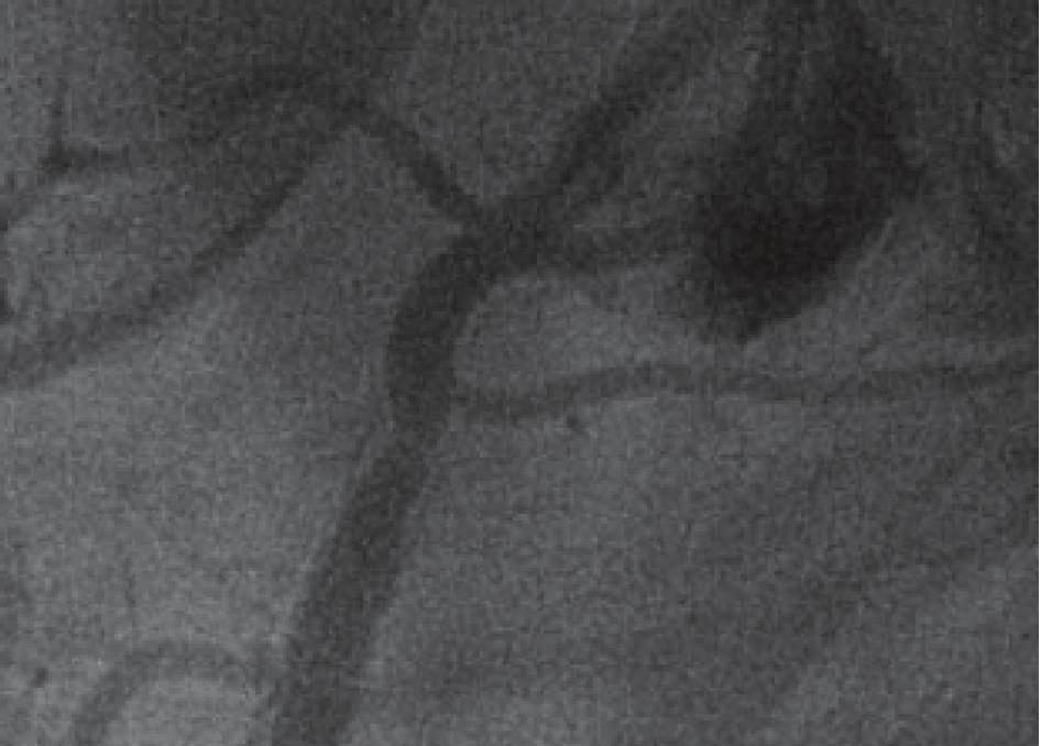 Our patient is the first described case to show regrowth of an occluded SB after a PTFE-covered stent implantation.