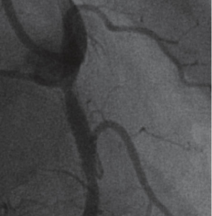 Intravascular ultrasound (IVUS) could not show any sign of flow to the SB at the level of its ostium, and PTFE-covered stent was well apposed to the first implanted stent (Figure 2(a)).