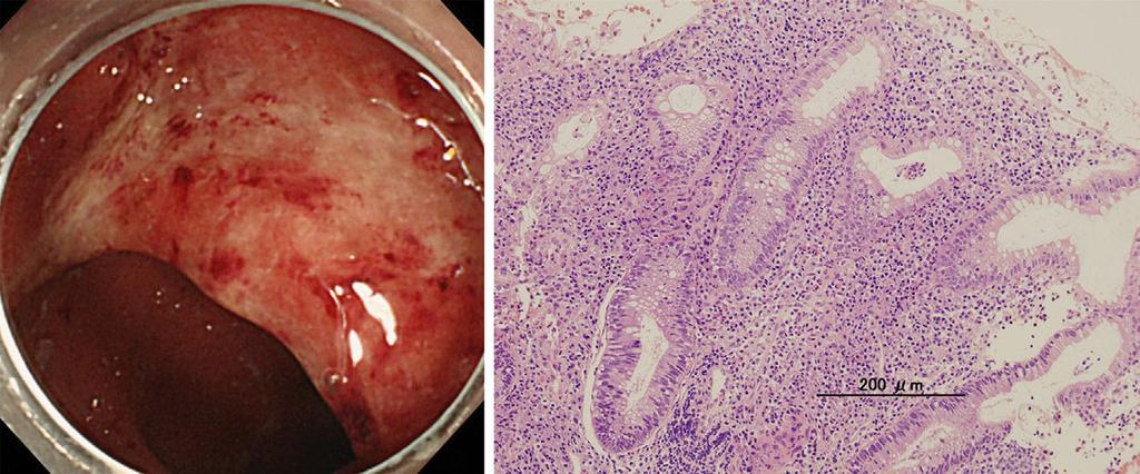 Figure 1. Endoscopic () nd histologicl findings () of the rectum t the initil dignosis. The iopsy specimen showed crypt scess. Figure 2. Colonoscopy of the trnsverse colon.