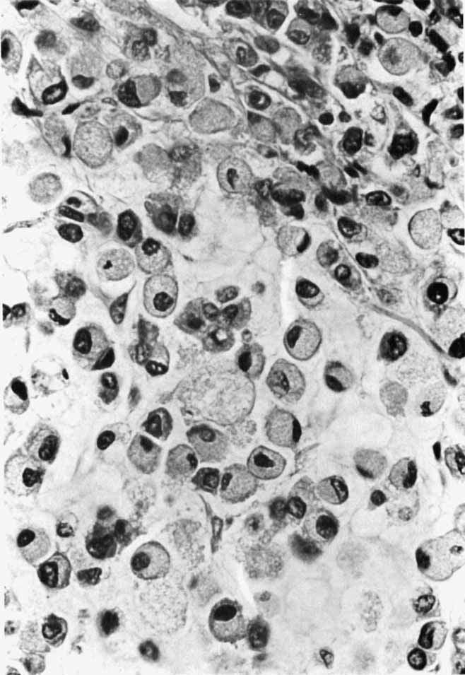 834 CANCER August 1 1981 Vol. 48 FIG. 2. The tumor was composed primarily of signet-ring-type cells with marked much production. Most areas resembled colloid carcinoma. (H & E, x400).