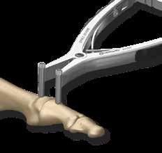 length. Place the barbed ends of the sizer/drill guide against the bone and verify that the selected bridge length is appropriate for the patient anatomy.