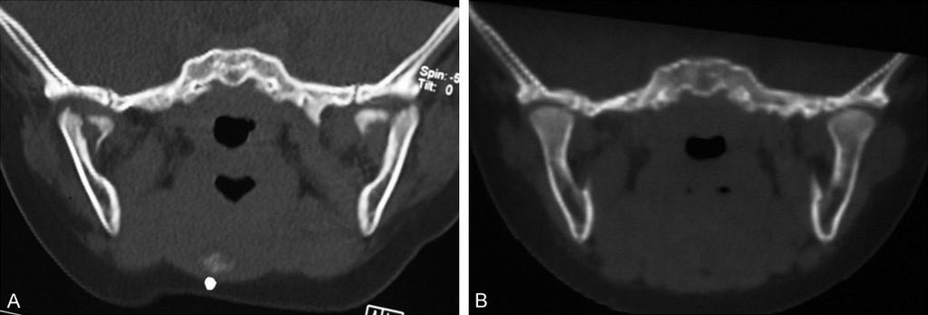 Figure 1. A 1-year-old female with bilateral intracapsular condylar fracture shows a complete reconstruction 6 month after non-surgical treatment. A. Coronal CT shows bilateral condylar fractures. B.