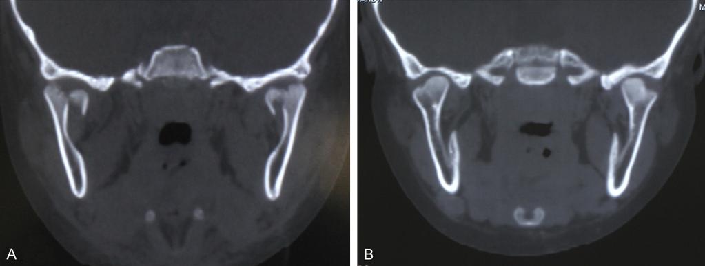 A 5-year-old female shows incomplete healing and reconstruction 1 year after bilateral condylar fractures were treated non-surgically. A.