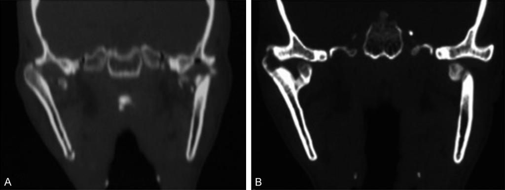 6 months after trauma, CT shows that the bilateral condylar morphology is very different from that of a normal condyle, and the right side shows a bifid condylar deformity. Figure 4.