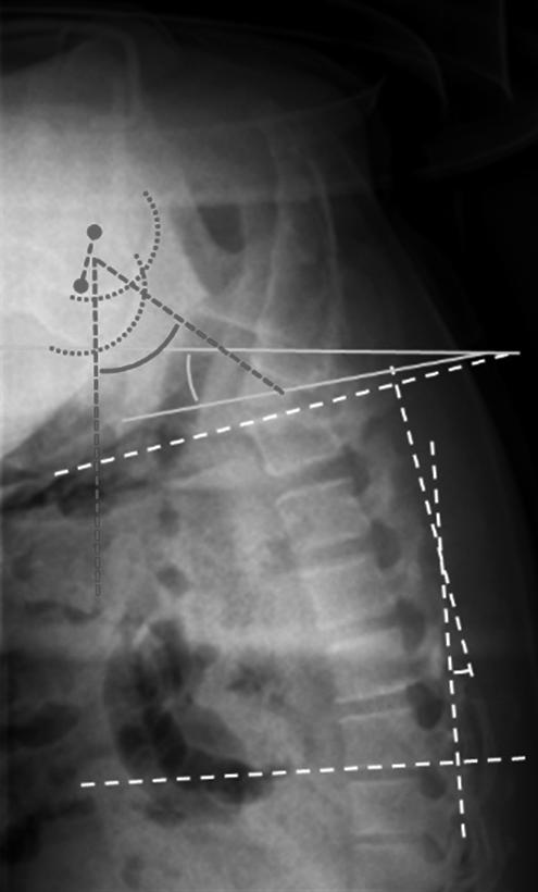 vertical line; and (4) pelvic incidence (PI), the angle between the line perpendicular to the sacral plate at its midpoint and the line connecting the midpoint to the axis of femoral heads (Fig. 2).