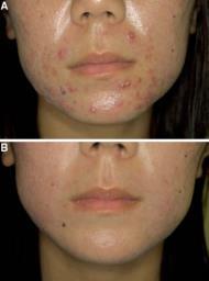Spironolactone for Acne 116 Asian females 64 completed 20wks 53% excellent response 47% good response Spironolactone for Acne: Combination Therapy 85 adult women 79%
