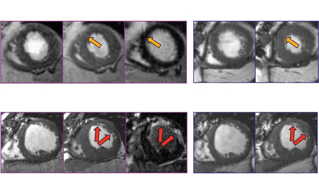 DE MRI pictures in patient with Reversible