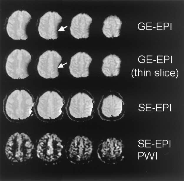 J. Wang et al. / Magnetic Resonance Imaging 22 (2004) 1 7 3 produce the time series of 180 perfusion-weighted images.
