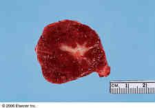 transplantation for giant hemangiomata Significant symptoms or diagnostic uncertainty Surgical resection Focal Nodular Hyperplasia (FNH) 8% of