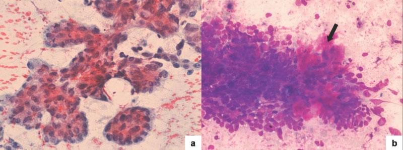 Inset: Two cells with well defined, clear cytoplasm. (b) A tigroid background with singly dispersed cells also was noted (Papanicolaou stain, original magnification 3200). FIGURE 2.