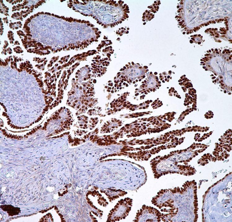 PAX-8 Pax 8 on ovarian ca Clone: MRQ-50 Visualization: Nuclear Ovarian Carcinoma (high sensitivity for serous