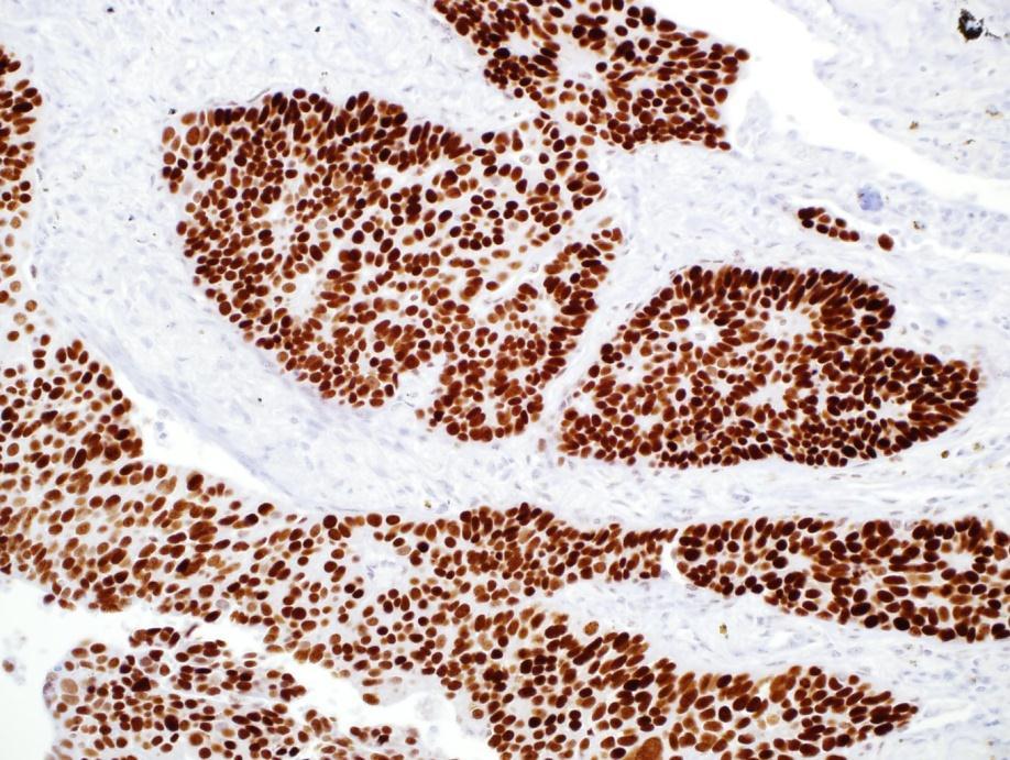 SOX-2 SOX-2 on Lung Squamous Cell Carcinoma Clone: SP76 Visualization: Nuclear Rabbit Monoclonal Differentiates lung squamous cell carcinoma from lung
