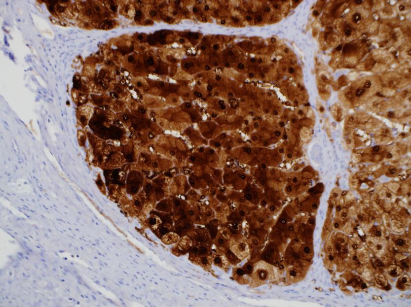 Arginase-1 Arginase 1 on cirrhotic liver Clone: SP156 Visualization: cytoplasmic and nuclear High sensitivity for HCC Useful for HCC