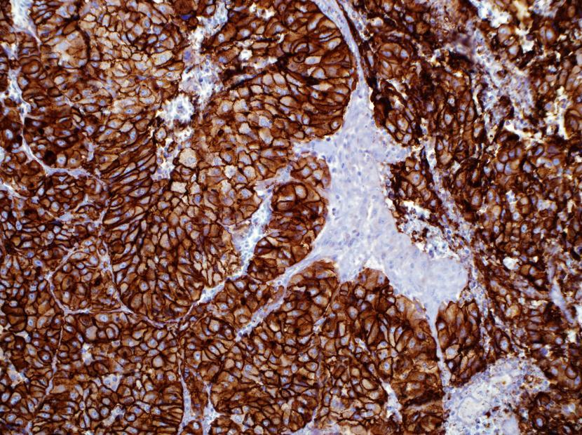 Glypican-3 Glypican-3 on HCC Clone: 1G12 Visualization: Cytoplasmic Differentiates benign liver from
