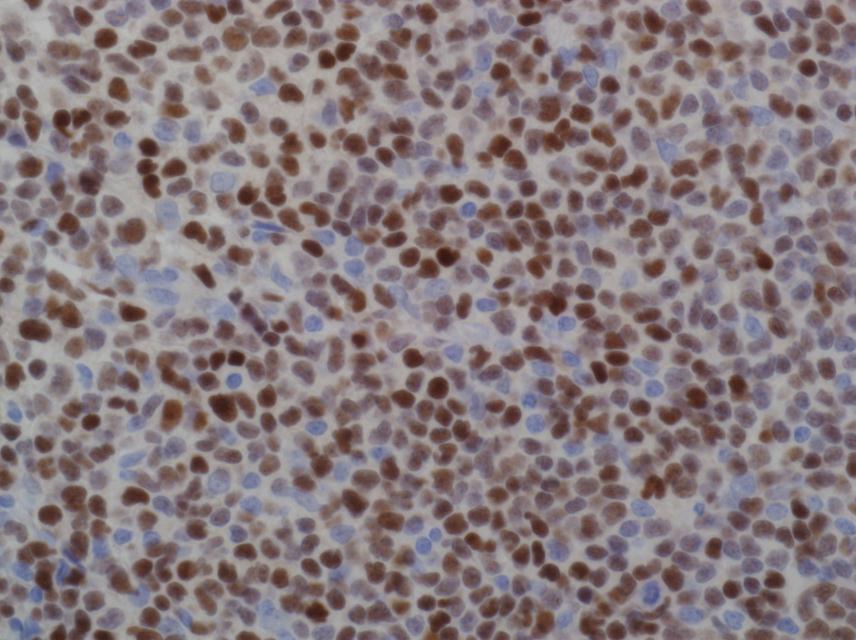 Sox-11 Sox-11 on Mantle Cell Lymphoma Clone: MRQ-58 Visualization: Nuclear Positive in 93-100% of all cyclin D1+ Mantle Cell Lymphomas and 100%