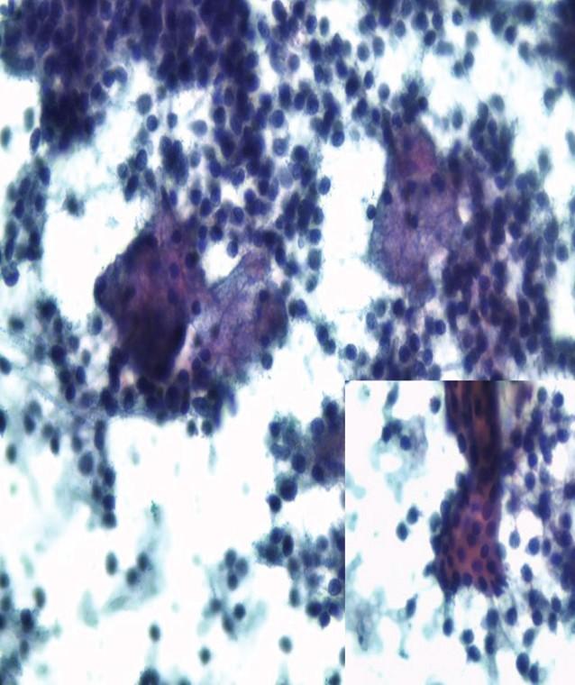 Microphotograph of fine needle aspiration cytology smear showing intermediate cells in clusters