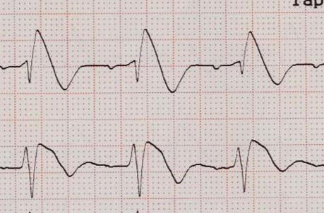 increased risk of ventricular arrhythmias which cause may syncope or sudden death, also as first
