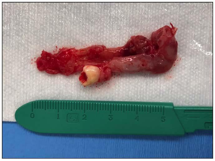Figure 2. Dentigerous Cyst. Image courtesy of Dr. S. Schwartz.