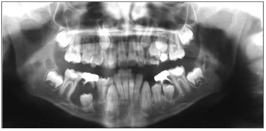 A benign cyst lined by squamous epithelium, the dentigerous cyst is found where fluid accumulates between the dental follicle and the crown of the unerupted or partially erupted tooth.
