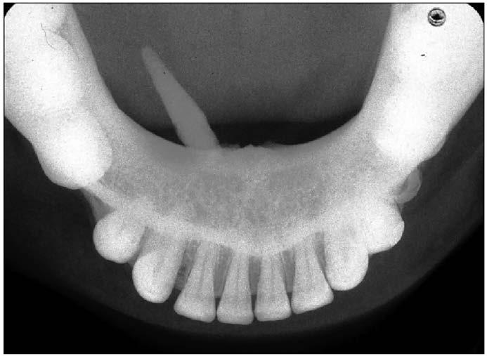Case #3 Diagnoses: Salivary Stone or Sialolith Radiographic Images: Figures 6-7 Demographics: Commonly diagnosed in middle-age adults, with 4% of cases occurring in individuals younger than 20 years
