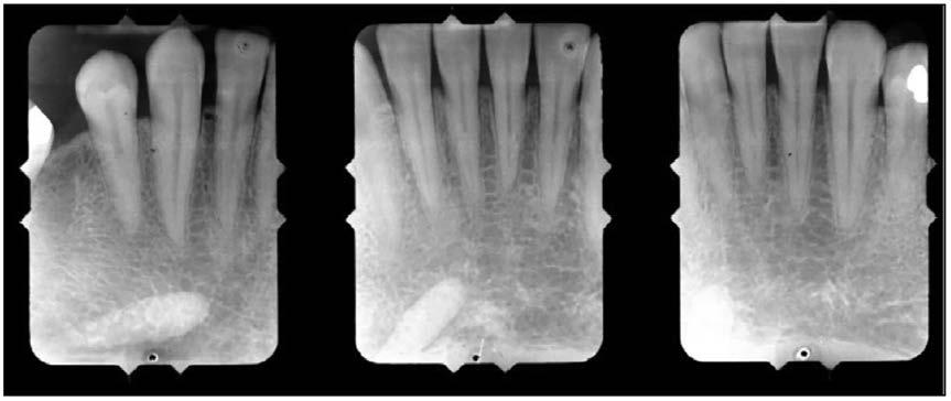 Figure 7. Periapical Images of a Sialolith. are typically asymptomatic. Radiographically salivary stones range from tiny particles to stones that are several centimeters in size.
