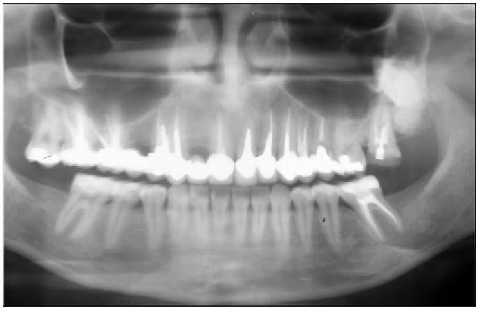 Figure 8. Panoramic Image of a Complex Odontoma. Figure 9. Periapical and Occlusal Images of an Odontoma. complex odontoma, like this case.