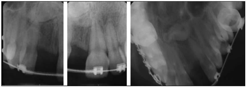 Compound odontomas occur in the canine and incisor region, found more often in the maxilla than mandible, and occur in children on average 14.8 years of age.