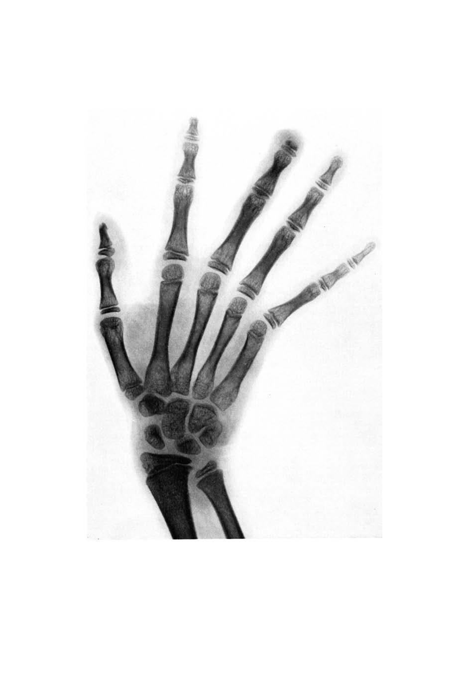 80 LEPROSY REVIEW X-ray of right hand showing early