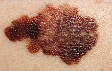 Case study: Stage III Melanoma Melanomas A skin cancer more prevaleant in Caucasians Most common in sunny climates (often correlated with latitude) Metastasise (Stage III) About 40% die within a year