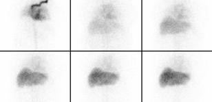 Functional Scintigraphy 3 weeks after Embolization Scintigraphy