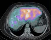 uptake in contralateral liver (blue arrow) SPECT/CT Fused images