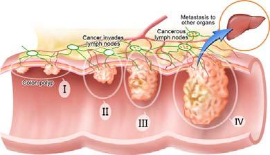 Clinical background Cancer of the colon