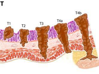 of colorectal carcinoma is the extent of