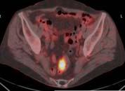 Summary Colorectal Cancer and FDG PET/CT Esophageal Cancer and FDG PET/CT Surgical planning of metastasis Detection