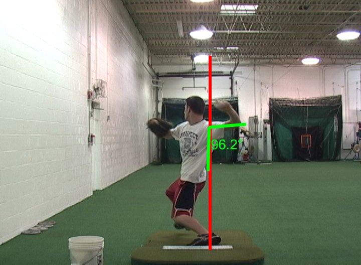 Elbow Flexion at Release Point (Labrum as well) Olecronon Pain (+) Bump Test Casting Curve Ball vs.