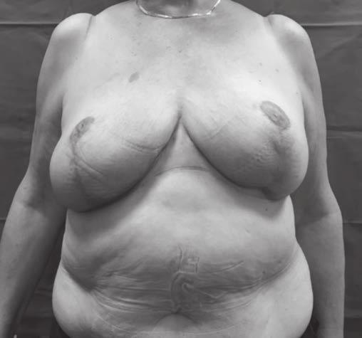 All the patients underwent breast reshaping after almost six months since the stabilization of their weight.