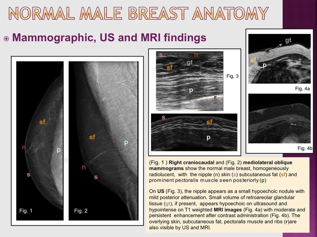 Imaging techniques may suggest the disease, but they are not usually diagnostic because the appearance of breast lymphoma may be variable. Diagnosis is almost always made on a histopathologic basis.