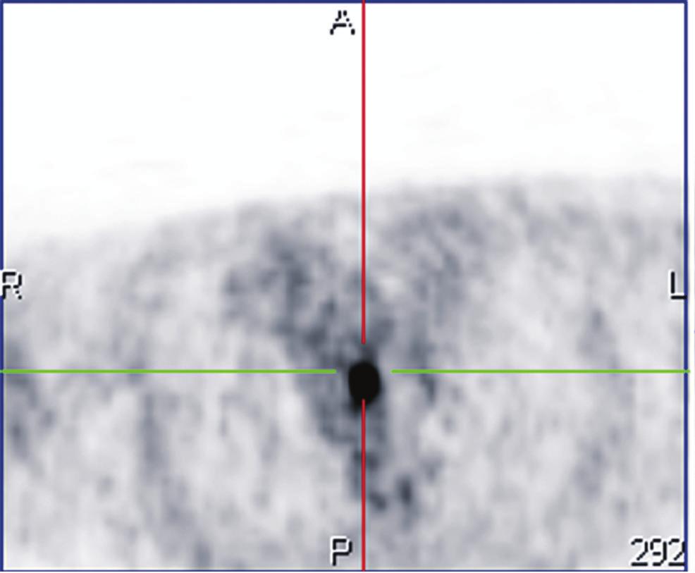 1 (a) (b) (c) Figure 1: PET scan shows a localized FDG uptake in the middle third of the trachea. (a): PET, (b): CT, (c): PET-CT.