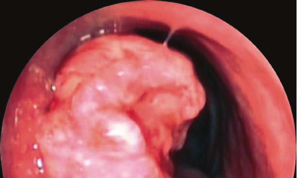 Virtual endoscopy demonstrates an endoluminal view of the tracheal tumor.