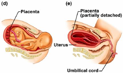 (c) through the ruptured amniotic sac.