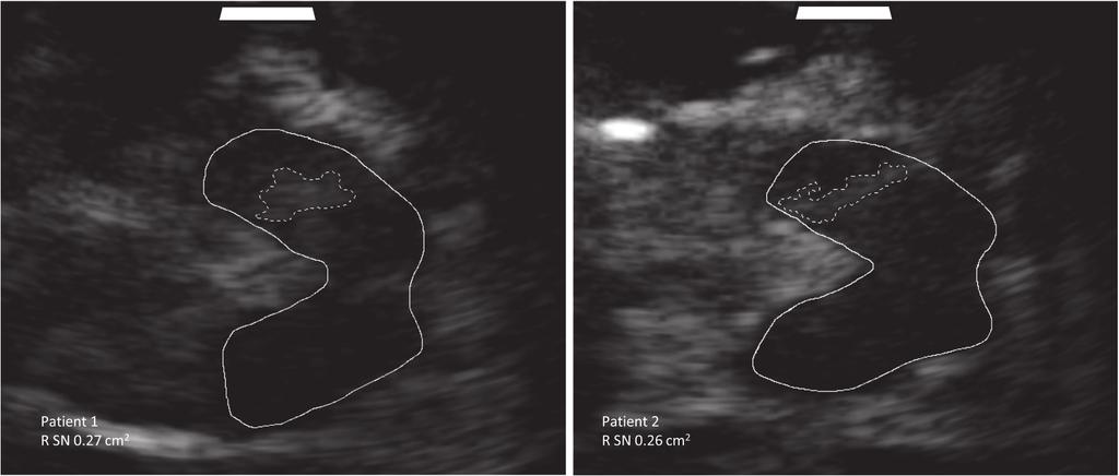 2 Case Reports in Neurological Medicine Figure 1: Transverse view of substantia nigra (SN) morphology in Patients 1 and 2 using transcranial sonography.