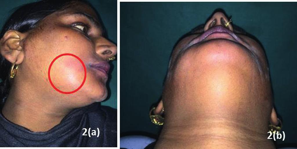 involving level of right commissural lip to the lower border of mandible (Fig. 2A and B). On palpation swelling was non-tender and afebrile. The left side swelling was not evident.