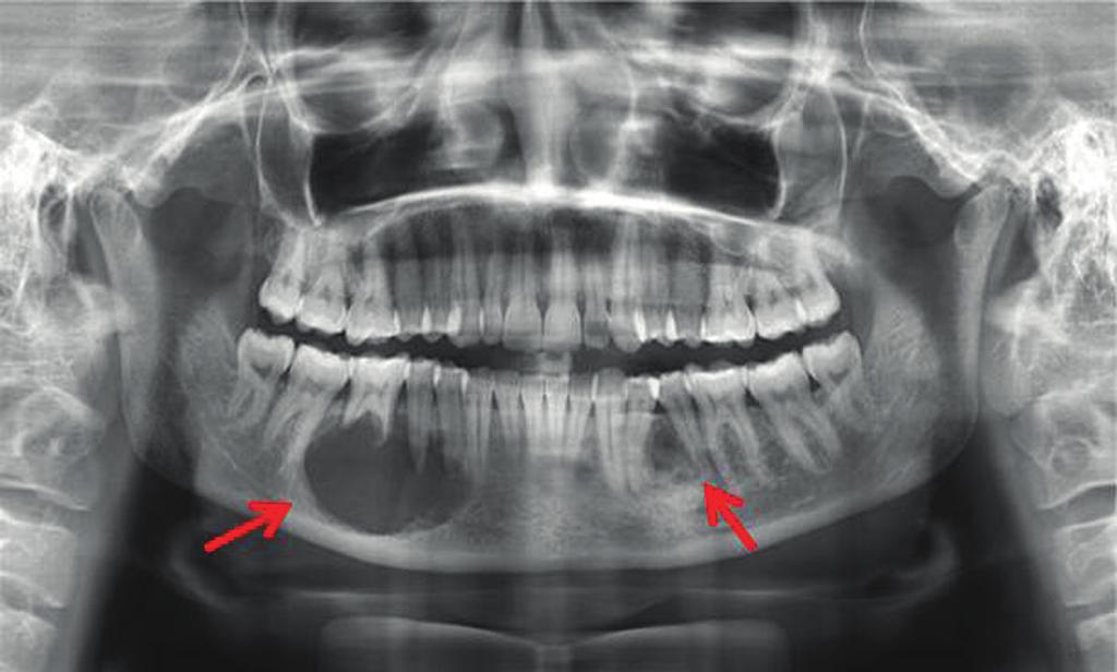 Electric pulp testing revealed that the teeth involved with the swelling were vital except 45 & 46 and nerve vitality was not disturbed.