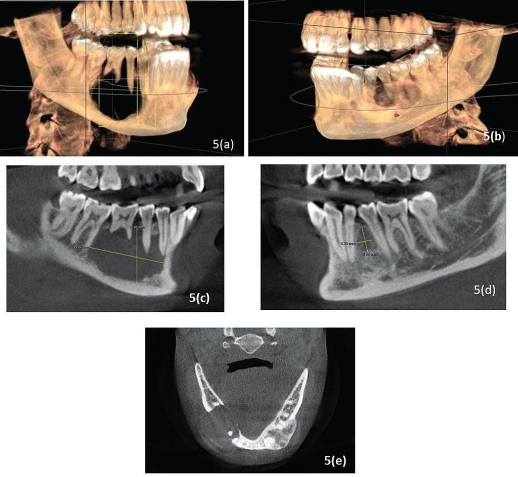 associated with root resorption in 45 & 46.
