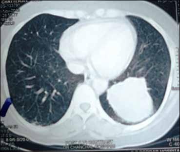 Fig.2: After treatment CT scan image done in November 2013 showing a stable disease. Fig.
