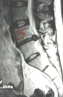 MRI Symptom