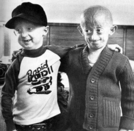 IJBCB, 37; 947 960 Definition: Progeria A disease characterized by symptoms of premature aging.