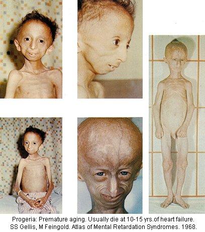 First described by Jonathan Hutchinson in 1886. Hastings Gilford gave it the name progeria and described it in 1904.